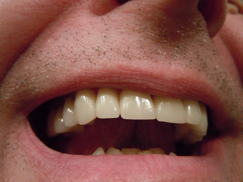 Odsłonięte szyjki zębowe - jak zapobiec cofaniu się dziąseł?